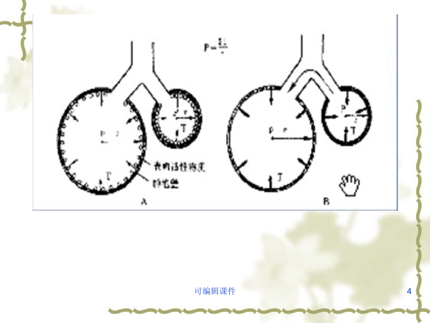 新生儿呼吸窘迫综合征ppt课件