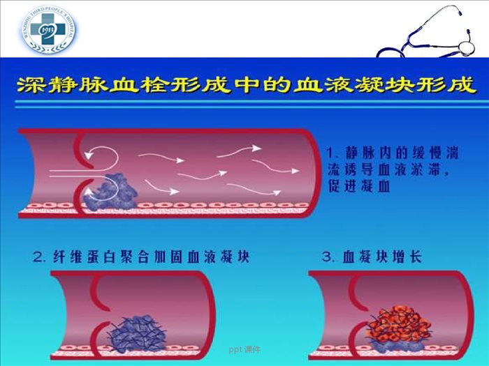 深静脉血栓预防及护理--ppt课件