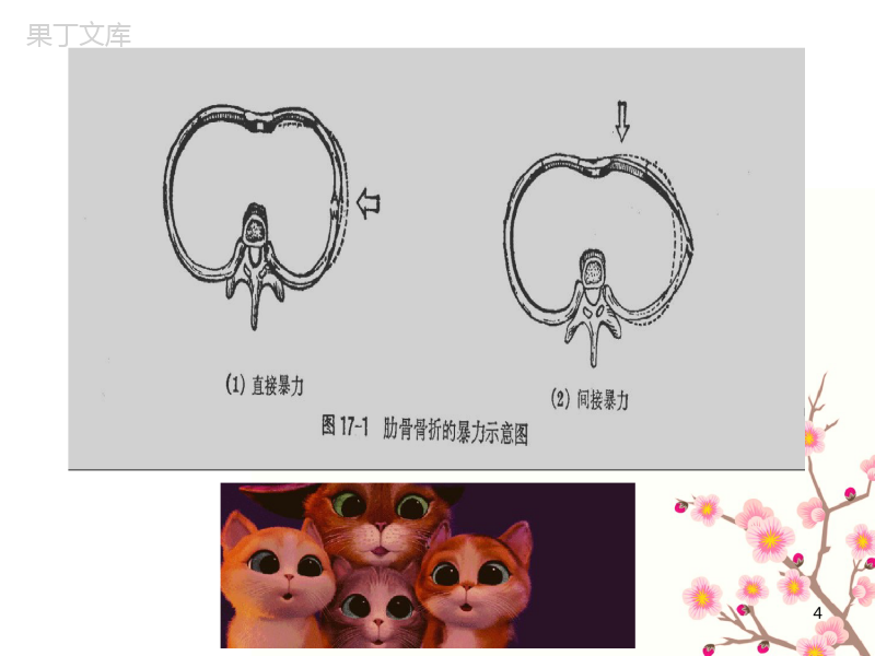 肋骨骨折护理查房PPT课件 (1)