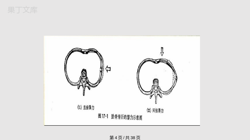 肋骨骨折护理查房PPT课件